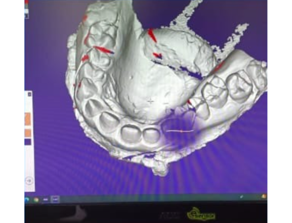 Exocad